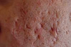 acne9